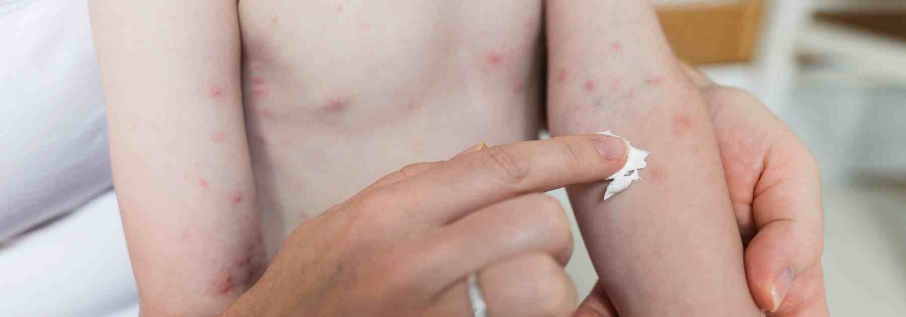 Impetigo treatment in Kennoway.