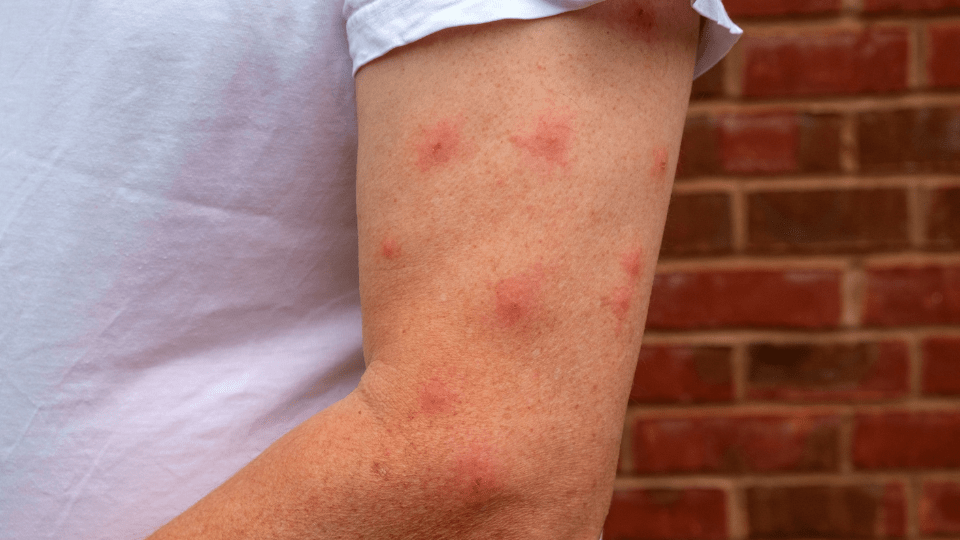 Infected inspect bite treatment and support in Kennoway