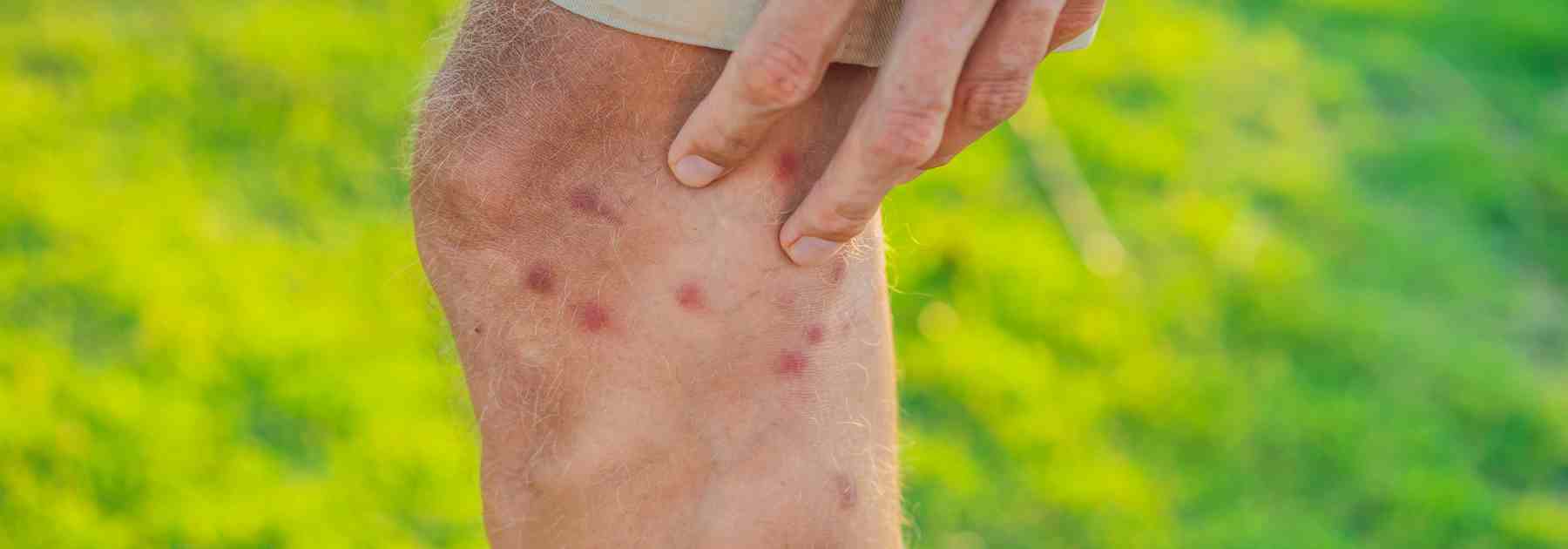 Treat infected insect bites in Kennoway